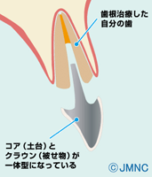 差し歯の仕組み　神経は抜かないといけないの？