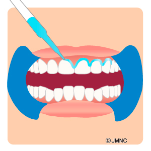 ホワイトニング クリーニングの無料イラスト素材集 歯科医院向け 審美歯科ネット