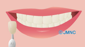 ホワイトニング クリーニングの無料イラスト素材集 歯科医院向け 審美歯科ネット