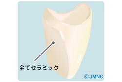 オールセラミックとは