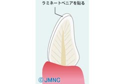 ラミネートベニア