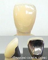 硬質レジン≪公的医療保険診療≫