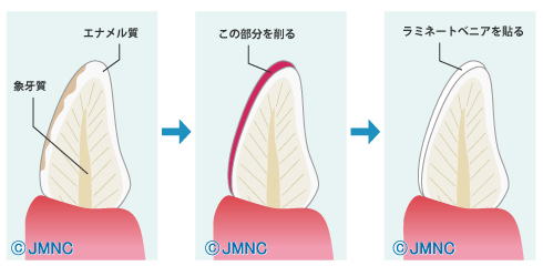 ラミネートべニア治療とは?