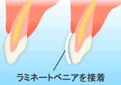 ラミネートべニア
