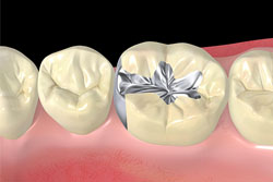 金属アレルギーのためのメタルフリーな歯科治療