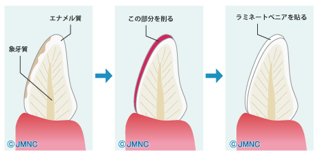 ラミネートべニアの治療法