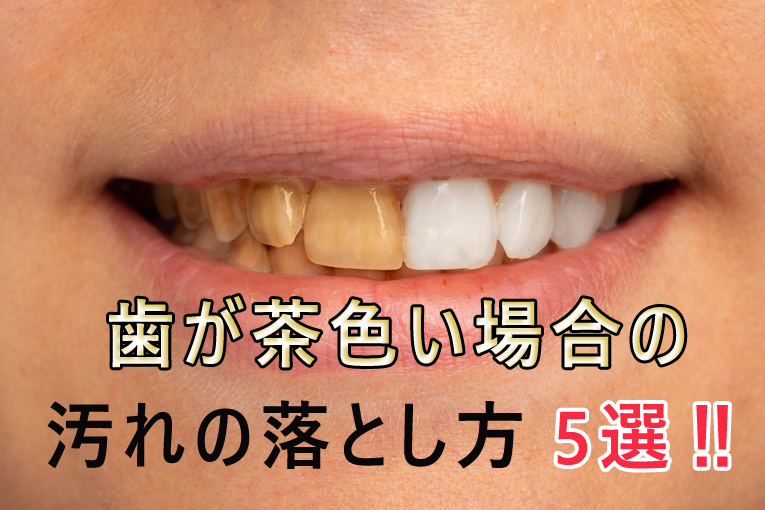 歯が茶色い場合の汚れの落とし方5選！歯が茶色い原因も解説