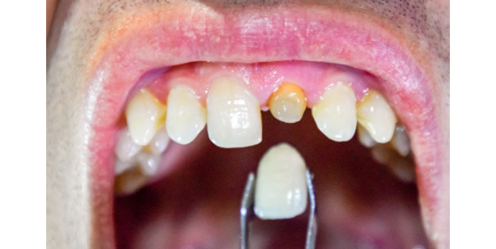 ceramic-orthodontics_img_12