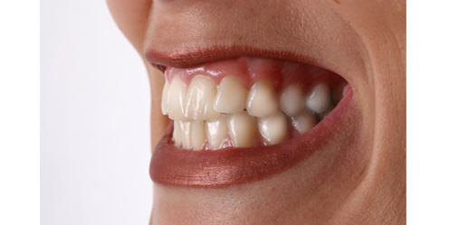 ceramic-orthodontics_img_14