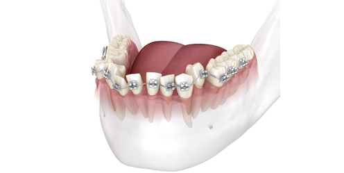 ceramic-orthodontics_img_2