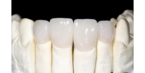ceramic-orthodontics_img_9