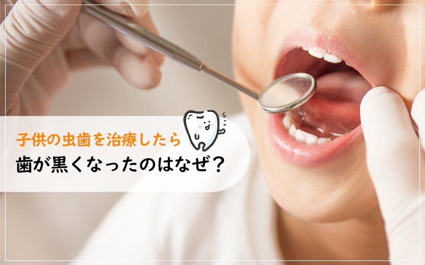 子供の虫歯を治療したら歯が黒くなったのはなぜ？