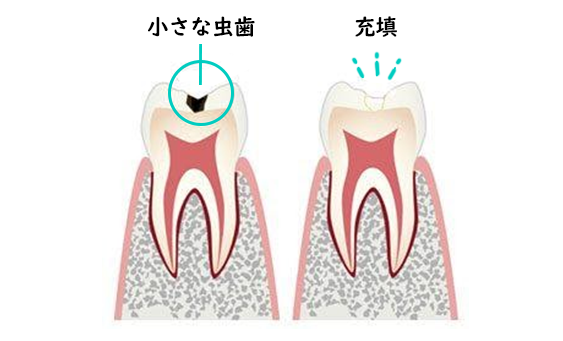 composite_resin_img_1