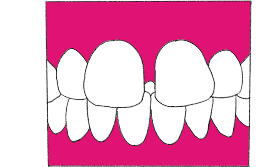 mouthpiece_partial_orthodontics_img_1