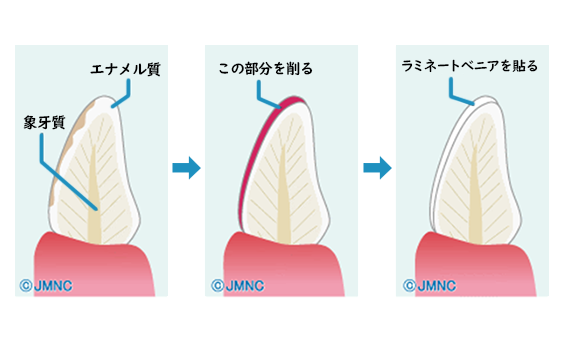 whiten_teeth_img_2