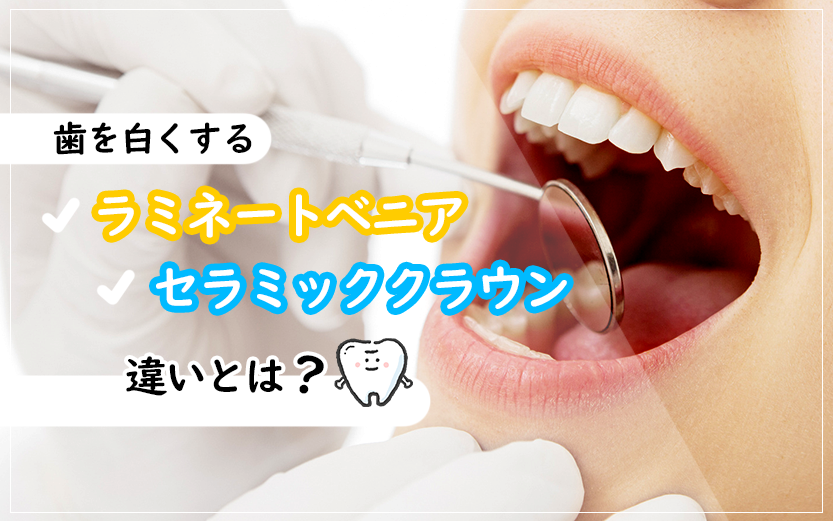 歯を白くするラミネートベニアとセラミッククラウンの違いとは？