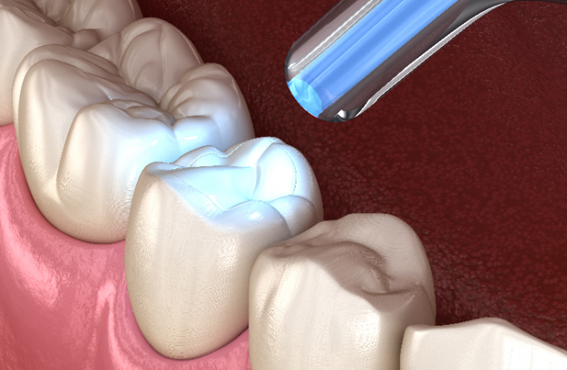 銀歯にしたくない場合の治療の選択肢