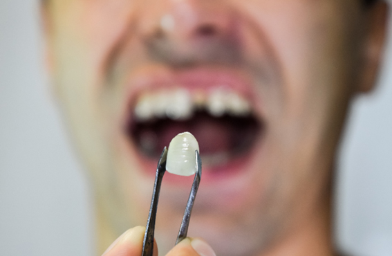 部位別！白い歯の治療方法