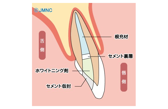 歯を白くしたい！黄ばんだ歯を白くする方法