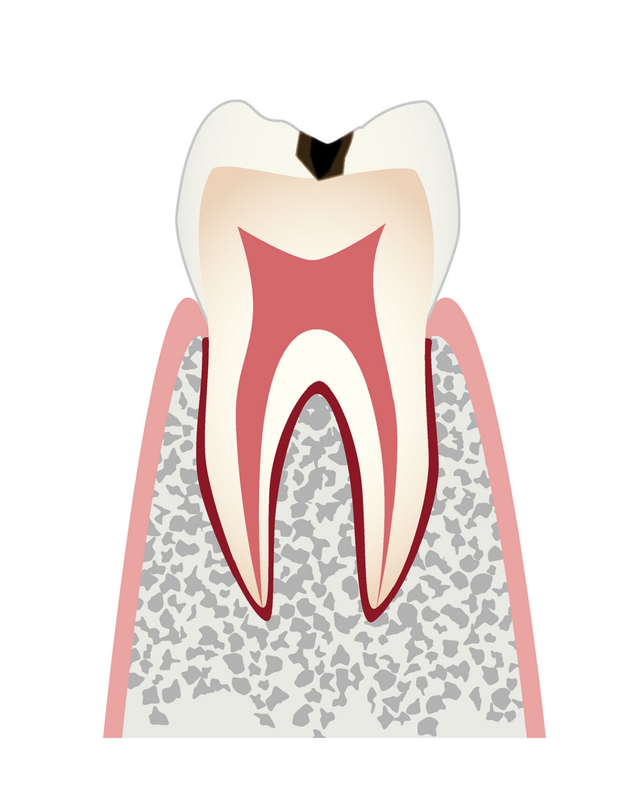 虫歯の進行c1