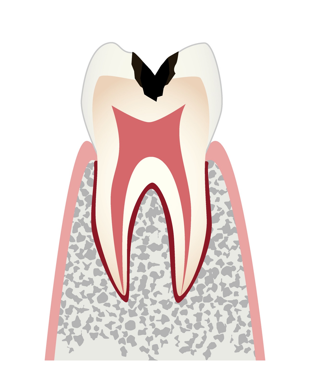 虫歯の進行c2