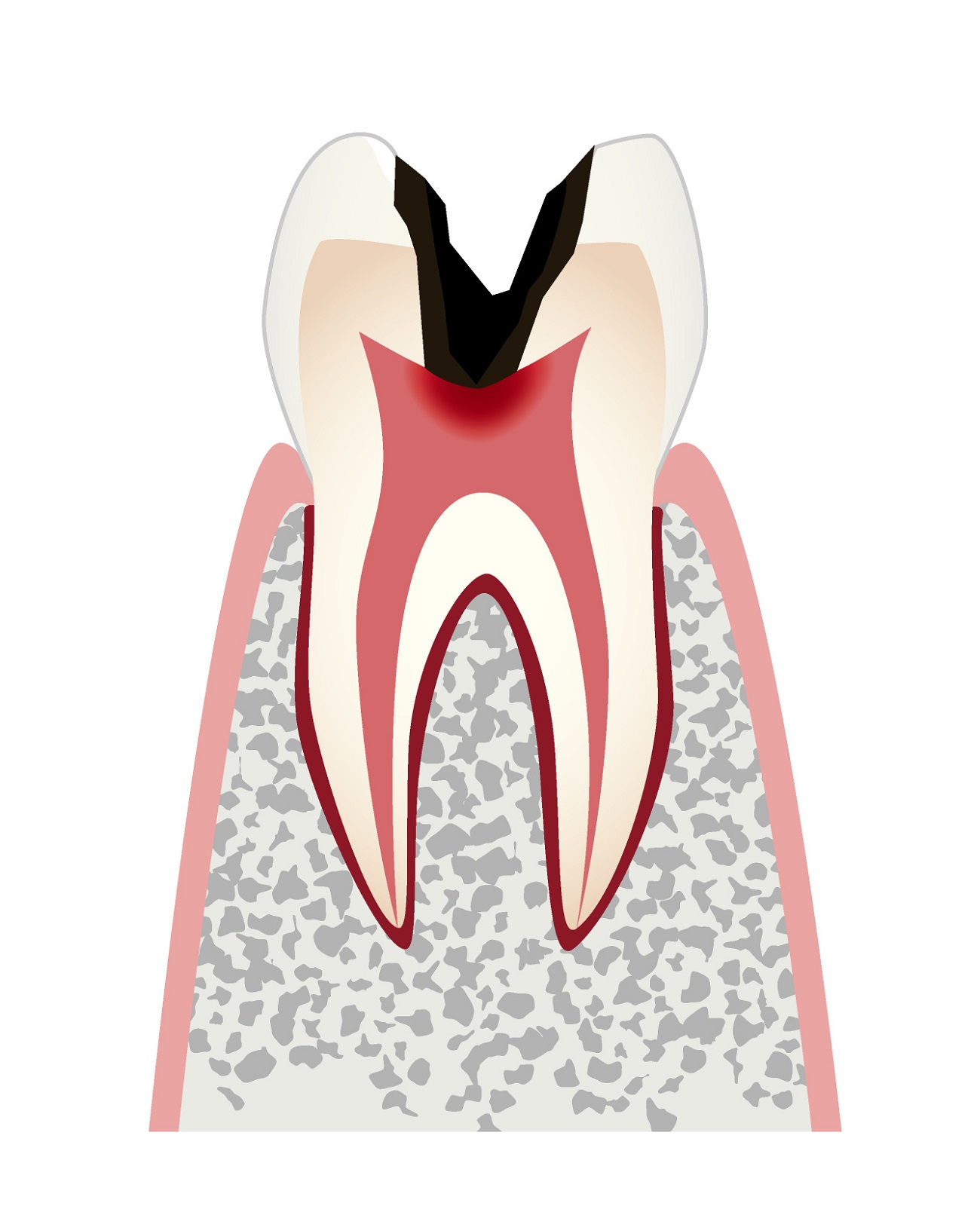 虫歯の進行c3