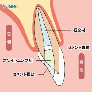 ウォーキングブリーチ