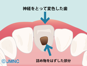 ウォーキングブリーチ前